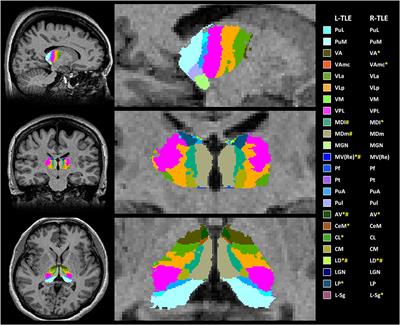 Characterization of Hippocampal-Thalamic-Cortical Morphometric Reorganization in Temporal Lobe Epilepsy